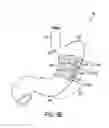 Fig. 09 - Gastric restriction devices for treating obesity