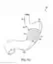 Fig. 10 - Gastric restriction devices for treating obesity
