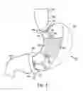 Fig. 19 - Gastric restriction devices for treating obesity