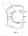 Fig. 23 - Gastric restriction devices for treating obesity
