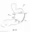Fig. 25 - Gastric restriction devices for treating obesity