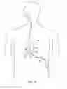 Fig. 28 - Gastric restriction devices for treating obesity