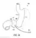 Fig. 43 - Gastric restriction devices for treating obesity