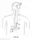 Fig. 51 - Gastric restriction devices for treating obesity