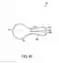 Fig. 55 - Gastric restriction devices for treating obesity