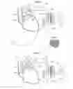 Fig. 12 - Device for treating obesity