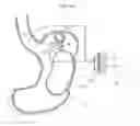 Fig. 15 - Device for treating obesity