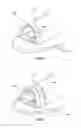 Fig. 03 - Devices and methods for nasal splinting