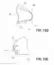 Fig. 15 - OCCLUSION DEVICE WITH OPENABLE CHANNEL