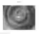 Fig. 11 - Devices and methods for creating a predictable capsulorhexis of specific diameter