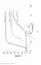 Fig. 04 - Bioadhesive for occluding vessels
