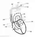 Fig. 01 - INTRAATRIAL VENTRICULAR ASSIST DEVICE