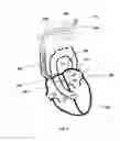 Fig. 02 - INTRAATRIAL VENTRICULAR ASSIST DEVICE