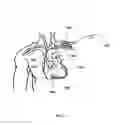 Fig. 04 - INTRAATRIAL VENTRICULAR ASSIST DEVICE