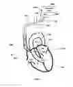 Fig. 09 - INTRAATRIAL VENTRICULAR ASSIST DEVICE