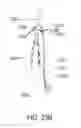 Fig. 16 - Unitary body systems and devices and methods to use the same for retroperfusion