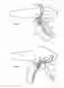 Fig. 45 - Apparatus, kits and related methods for fluid infusion