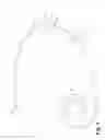 Fig. 02 - Cinching peritoneal dialysis catheter