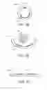 Fig. 07 - Percutaneously implantable paddle-type lead and methods and devices for deployment