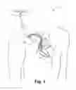 Fig. 02 - Criteria for optimal electrical resynchronization during biventricular pacing