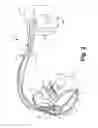 Fig. 03 - Criteria for optimal electrical resynchronization during biventricular pacing