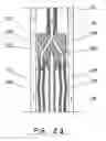 Fig. 24 - Apparatus for drilling deeper and wider well bore with casing
