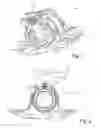Fig. 02 - Sensor device with mounting means