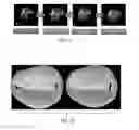 Fig. 06 - Valve modeling with dense chordae from medical scan data