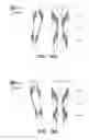 Fig. 11 - LIFTING RESILIENT GARMENT AND METHOD FOR ADJUSTING THE SAME