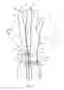 Fig. 13 - METHOD OF MAKING POLYMERIC GLOVES HAVING EMBEDDED SURGICAL SUPPORT SYSTEMS AND DISCRETE ELEMENTS