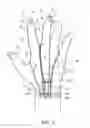 Fig. 14 - METHOD OF MAKING POLYMERIC GLOVES HAVING EMBEDDED SURGICAL SUPPORT SYSTEMS AND DISCRETE ELEMENTS