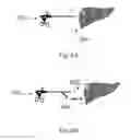 Fig. 10 - Device and method for assisting laparoscopic surgery—rule based approach