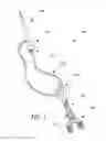 Fig. 02 - Meniscus horn relocation device and method