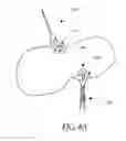 Fig. 08 - Meniscus horn relocation device and method