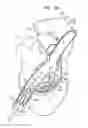 Fig. 06 - ANCHOR-DELIVERY SHEATH TIP