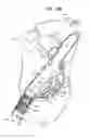 Fig. 07 - ANCHOR-DELIVERY SHEATH TIP