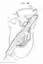 Fig. 11 - ANCHOR-DELIVERY SHEATH TIP