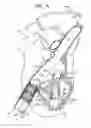 Fig. 16 - ANCHOR-DELIVERY SHEATH TIP