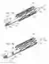 Fig. 18 - ANCHOR-DELIVERY SHEATH TIP