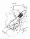 Fig. 19 - ANCHOR-DELIVERY SHEATH TIP