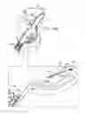 Fig. 62 - ANCHOR-DELIVERY SHEATH TIP