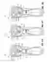 Fig. 83 - Flexible endoscopic stitching devices