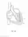 Fig. 43 - Suturing devices and methods for suturing an anatomic valve