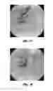Fig. 03 - Occluding device and method of occluding fluid flow through a body vessel