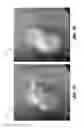Fig. 07 - Occluding device and method of occluding fluid flow through a body vessel
