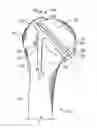 Fig. 01 - Patient-specific cutting guide for the shoulder