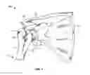 Fig. 02 - Patient-specific cutting guide for the shoulder
