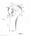 Fig. 04 - Patient-specific cutting guide for the shoulder