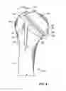 Fig. 05 - Patient-specific cutting guide for the shoulder