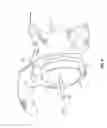 Fig. 08 - Patient-specific cutting guide for the shoulder